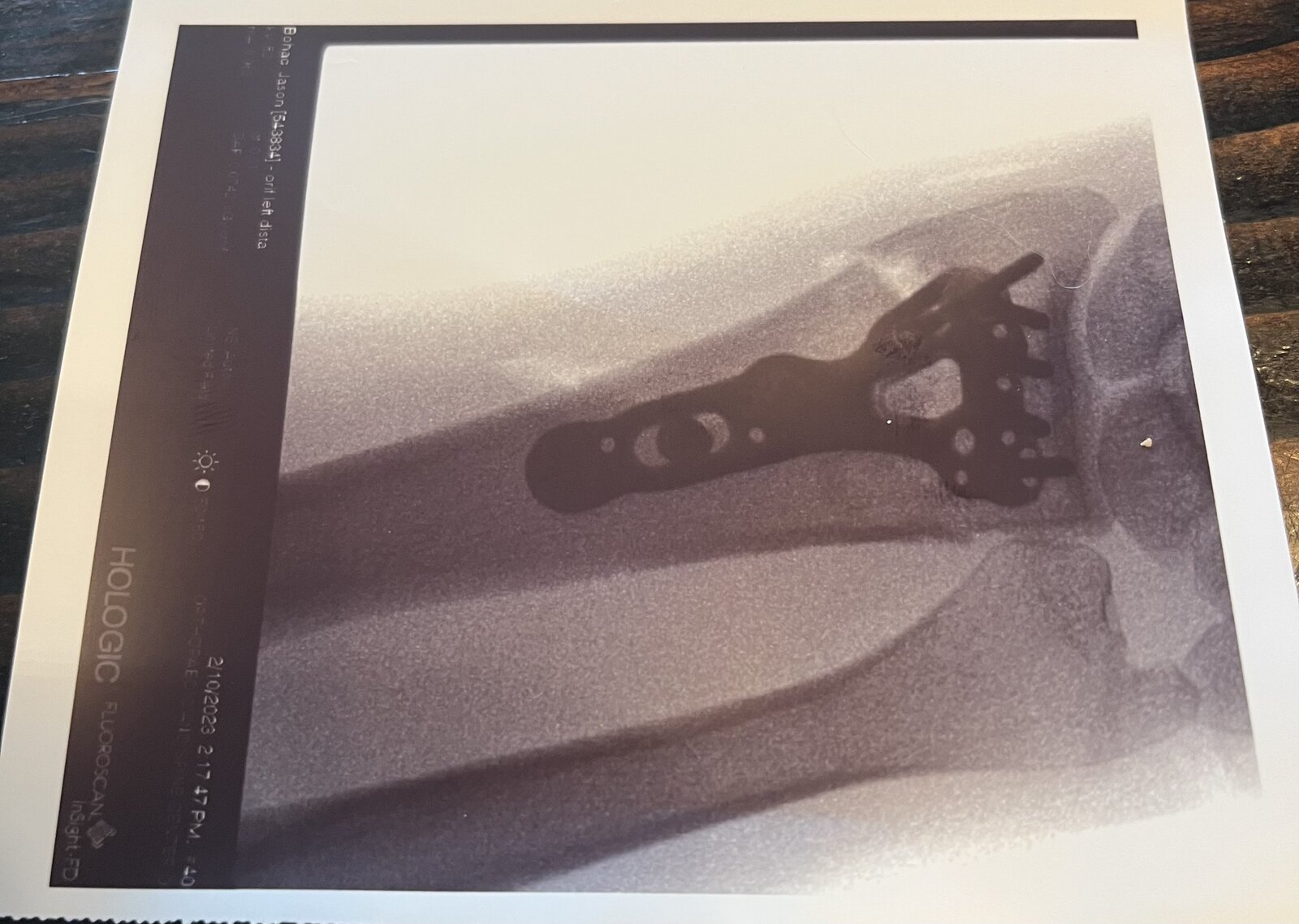 Forgot to post for a couple years… Whatta ride. ⚠️ Trigger warning: broken  bone X-rays if you're into that sorta thing. ⚠️